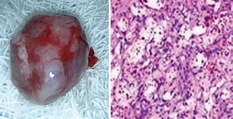 Figure 4 from Pediatric Lobular Capillary Hemangioma Nasal Cavity | Semantic Scholar