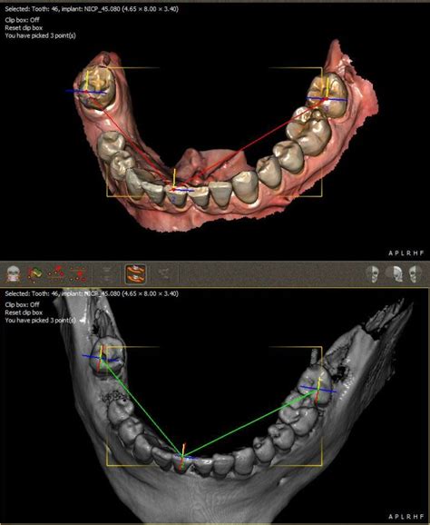 Quickvision 3D software de planificación de implantes para dentistas