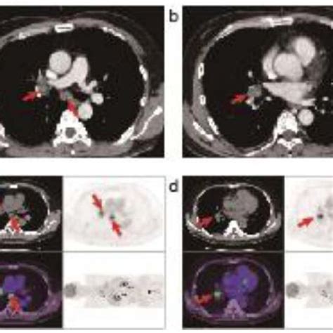 Findings On Imaging Of Lesions In Hilar And Mediastinal Lymph Nodes Download Scientific