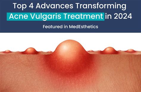 Top 4 Advances Transforming Acne Vulgaris Treatment in 2024 • Aerolase