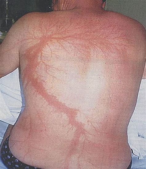 Scars after a lightning strike : r/creepy