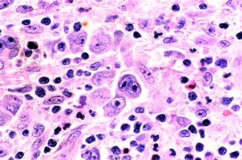 Hodgkin Lymphoma: Nodular Sclerosis Type