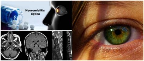 Neuromielitis Óptica Definición Causas Síntomas Diagnóstico y