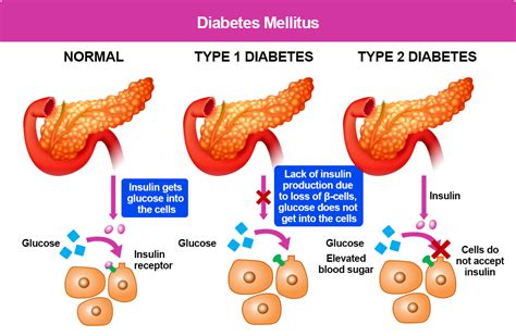 What is Type 1 Diabetes? – T1D