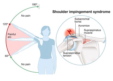 Shoulder Impingement Explained Whitefish Chiropractic Center