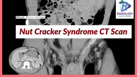 nut cracker syndrome ct scanhaematurialeft renal vein compression