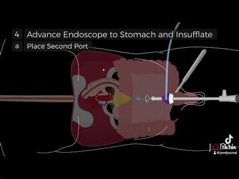 Laparoscopic Assisted Percutaneous Endoscopic Gastrostomy PEG Tube