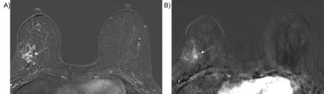 Predicting DCIS Upgrade To Invasive Cancer At Breast Surgery With