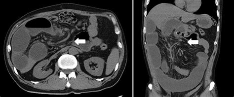 Computed tomography examination of the internal hernia. The small... | Download Scientific Diagram