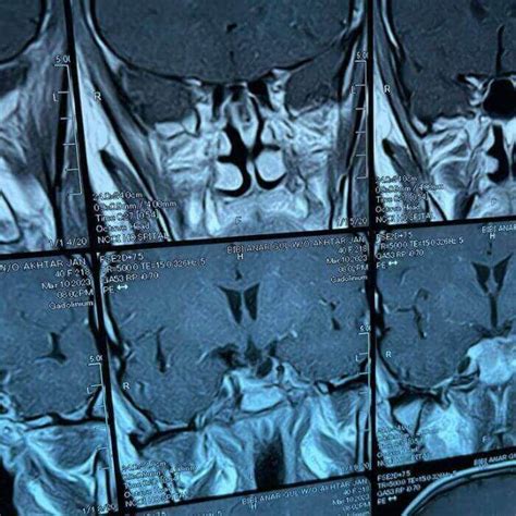 Case Report 2019: Pituitary Adenoma – Neurospinal & Cancer Care ...