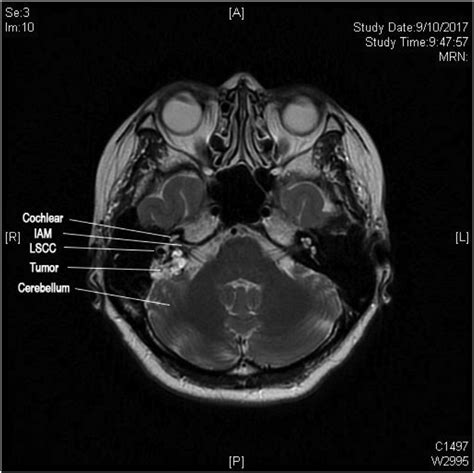 Internal Acoustic Meatus Contents