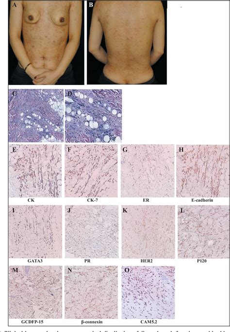 Symmetrical Distribution Of Nodular Scleroderma Like Cutaneous