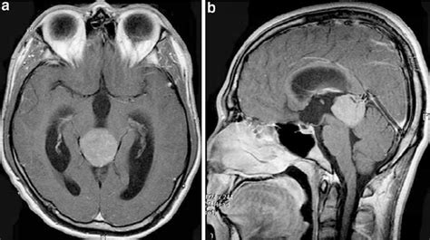 Pretreatment Gadolinium Enhanced Axial A And Sagittal B