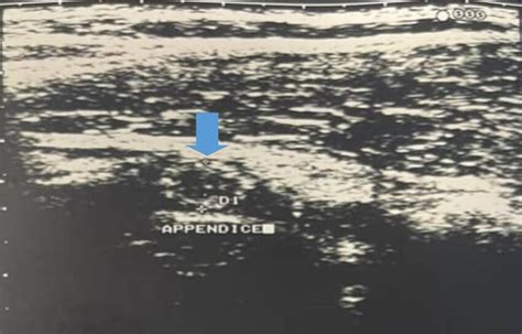 ultrasound image of an enlarged appendix (blue arrow) | Download ...