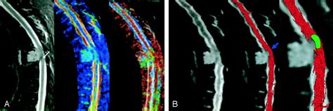 MR Diffusion Tensor Imaging And Fiber Tracking In Spinal Cord