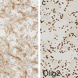 Morphological And Immunohistochemical Features Of Rosette Forming