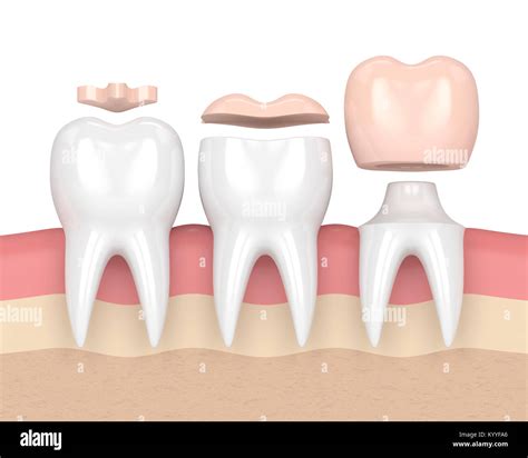 D Render Of Teeth With Inlay Onlay And Crown Filling In Gums Stock