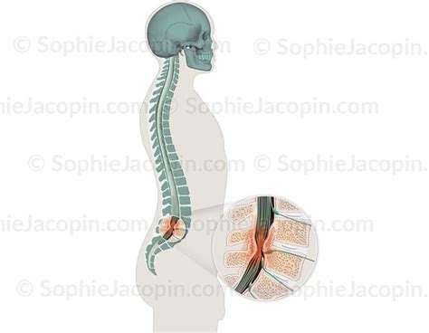 STÉNOSE LOMBAIRE illustration medicale Sophie Jacopin