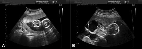 Comment On Ultrasonographic Diagnosis Of Intrauterine Fetal