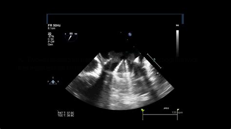 Mechanical Mitral Heart Valve