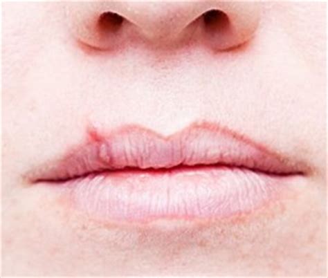 Cold Sore Symptoms That Are Commonly Experienced