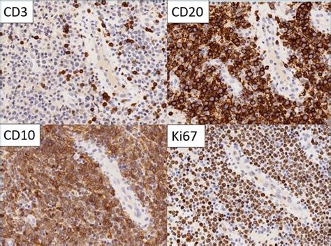 Immunohistochemistry The Large Cells Expressed Cd And Cd And