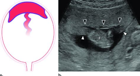 Circumvallate placenta symptoms, diagnosis, risks, complications ...