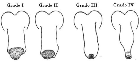 Fimosis Y Circunsición Clases De Fimosis