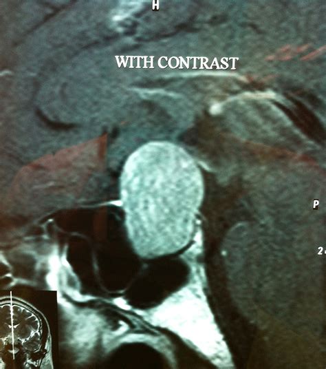 Non Functioning Pituitary Macroadenoma The Hku E Learning Platform In