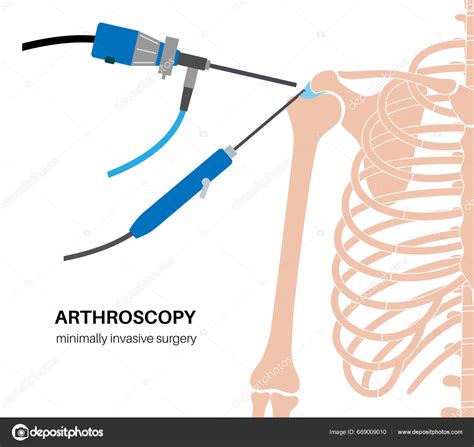 Shoulder Arthroscopy Procedure Rotator Cuff Tears Shoulder Joint ...