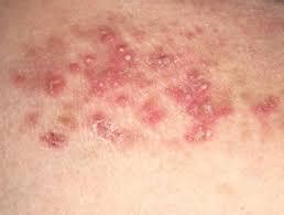 Best Pustular Psoriasis Treatment In Vasai Mumbai Natural Cure For