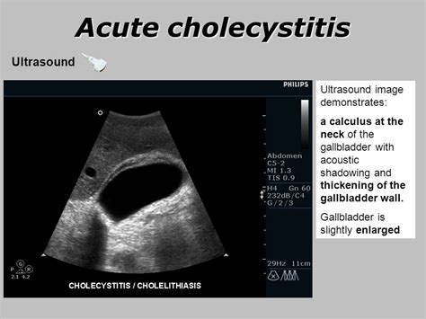 Multiple Gallbladder Calculi Calculus Of Gallbladder With Acute