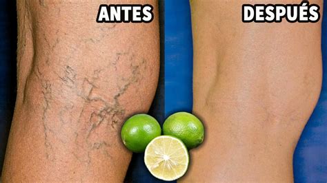 Sólo Usar Estos 2 Ingredientes Para Eliminar Las Varices Rápidamente