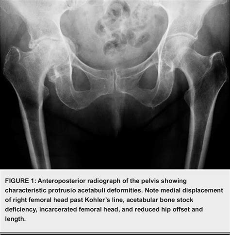 Figure From Managing Protrusio Acetabuli With A Direct Anterior