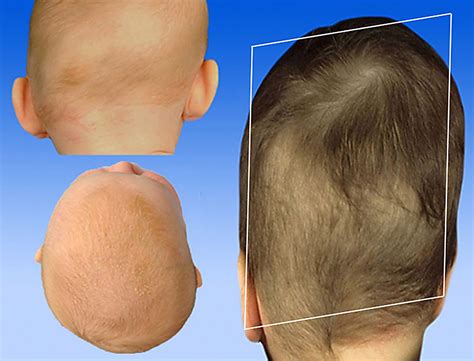 Anterior Plagiocephaly