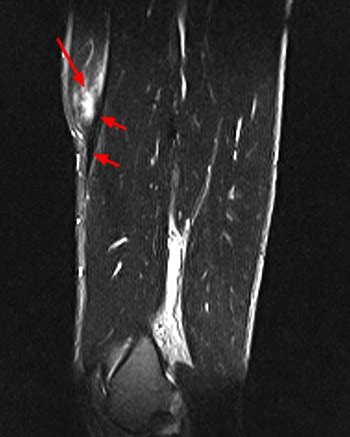 MRI of Rectus Femoris / Quadriceps Injury - Radsource