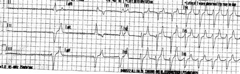 Dr Smiths Ecg Blog St Elevation And A Wide Qrs Ems Activates The Cath Lab