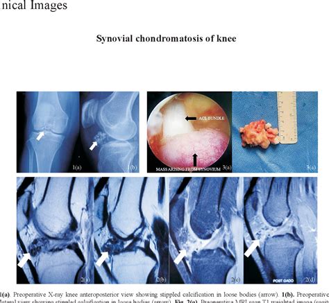 Figure 1 From Synovial Chondromatosis Of Knee Semantic Scholar