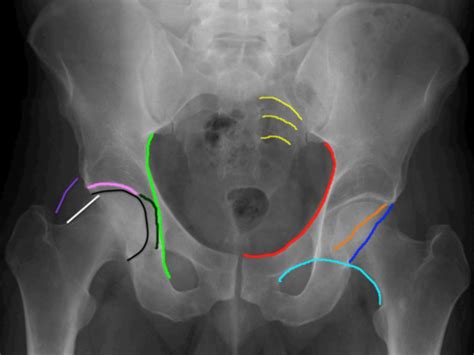 Trauma Of The Pelvis Flashcards Quizlet