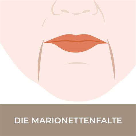 Marionettenfalten