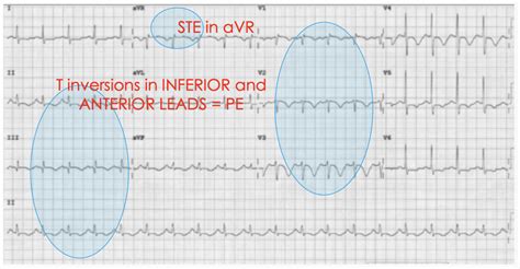 Ecgs Of Pulmonary Embolism Cardiac Bootcamp