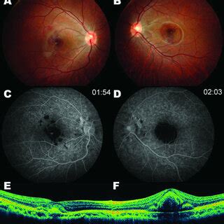 Fundus Photography A B Fluorescein Angiography C D Optical