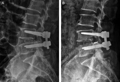 Risk Factors For Cage Migration And Cage Retropulsion Following