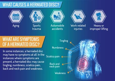 Herniated Disc Causes And Prevention Tips Lifehack