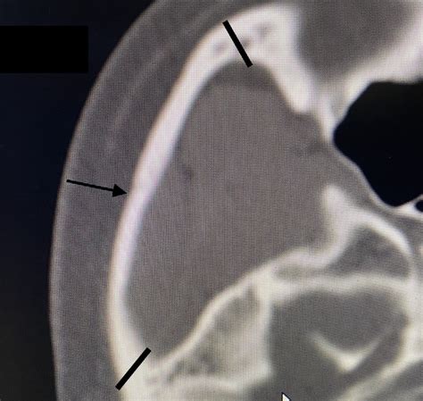 The Anatomy And Technique Of Zygomatic Arch Osteotomies In Cheekbone