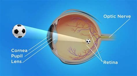 All About Myopia: Causes, Symptoms, Treatments and Prevention