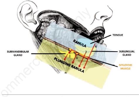 Figure 1 From Plunging Ranula In Children Case Report And Literature