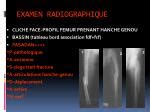 Ppt Fractures De La Diaphyse Femorale Powerpoint Presentation Id