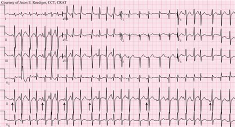 Multifocal atrial tachycardia - WikEM