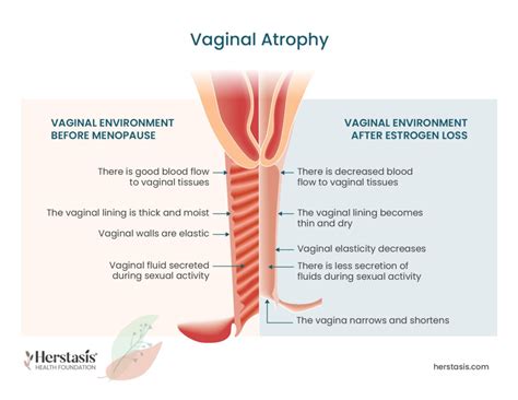 Menopause Vaginal Changes - Therapies for Vaginal Dryness - Blood flow ...